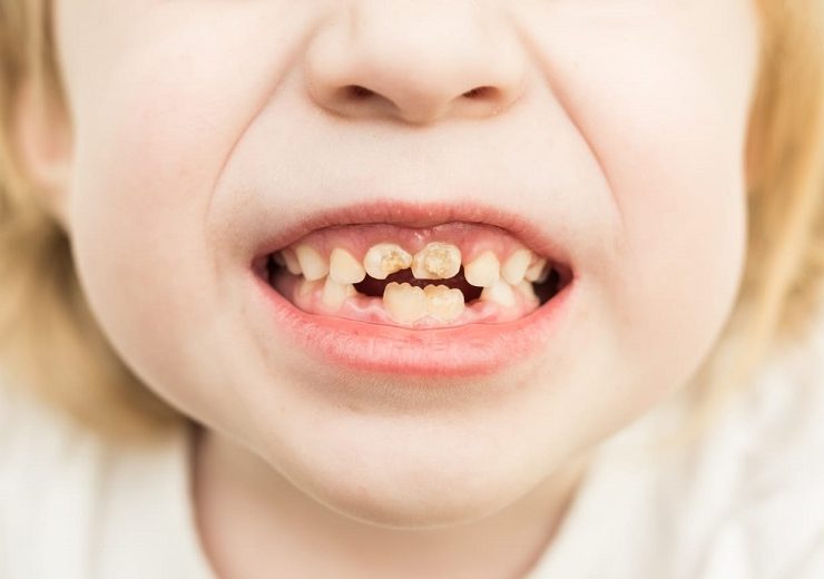 Bad Teeth